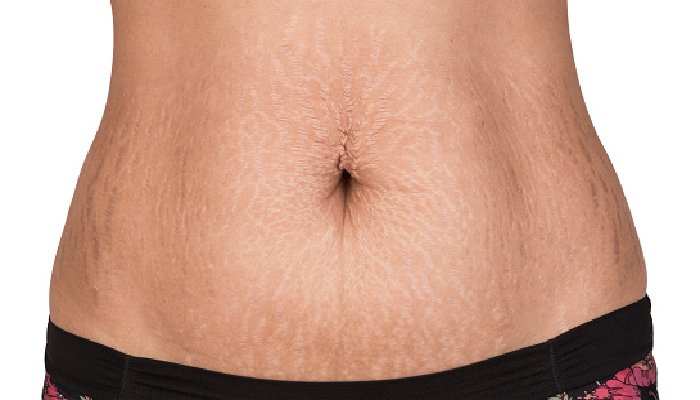 Stretch Marks, How To Fight Them_ (1)