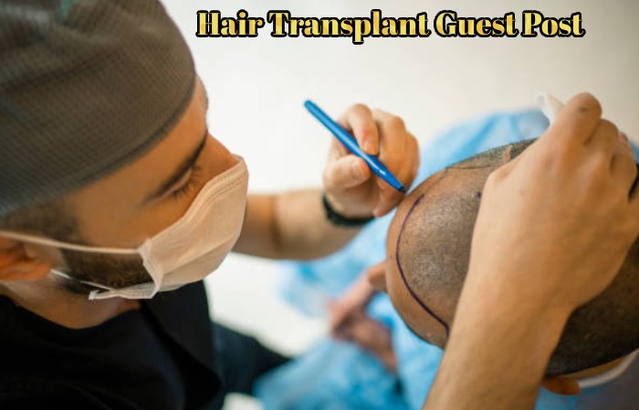 Hair Transplant Guest Post