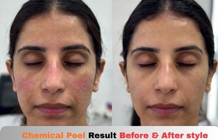 chemical peel result before & after style